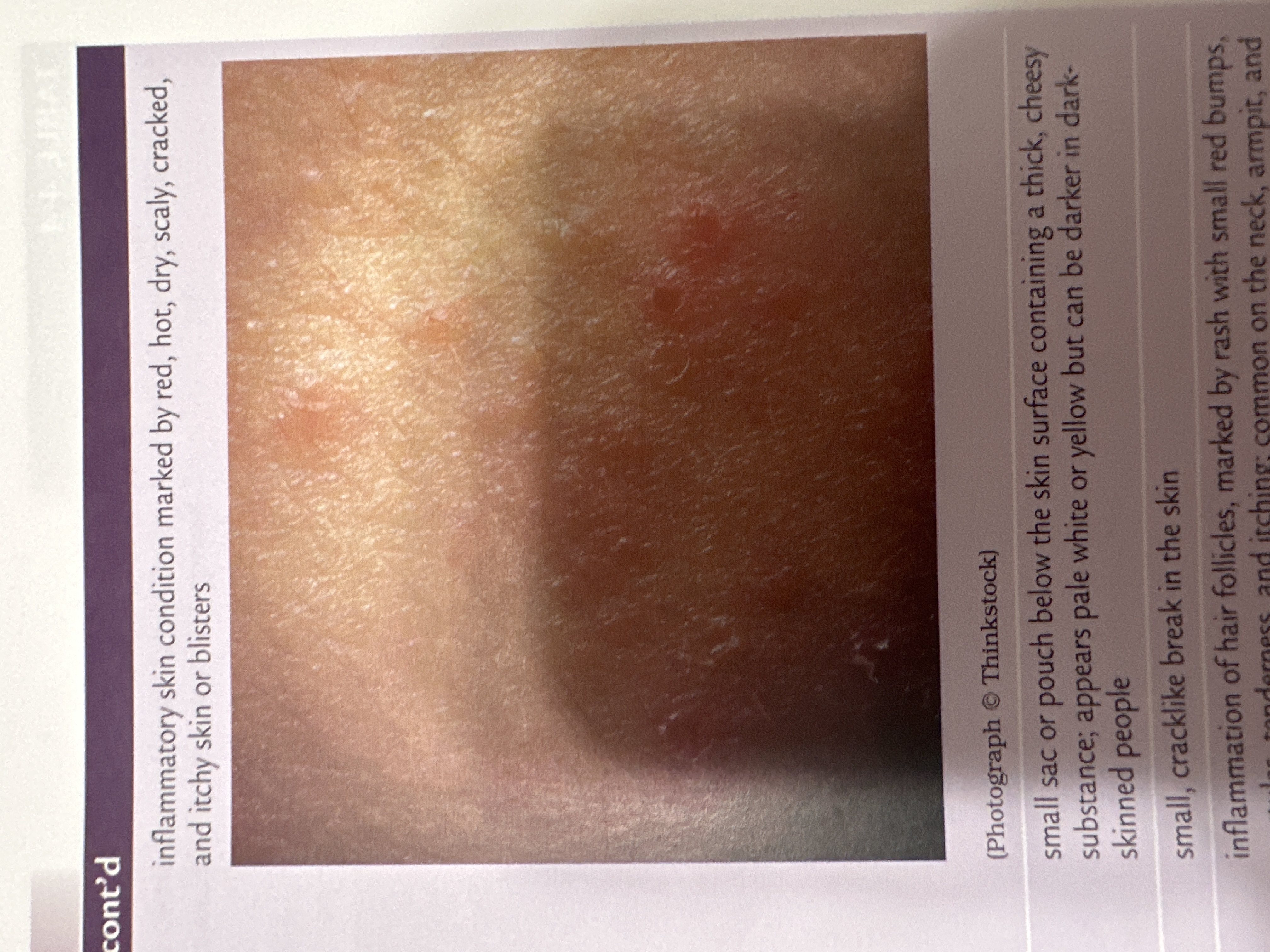 inflammatory skin condition marked by red, hot, dry, scaly, cracked, and itchy skin or blisters
