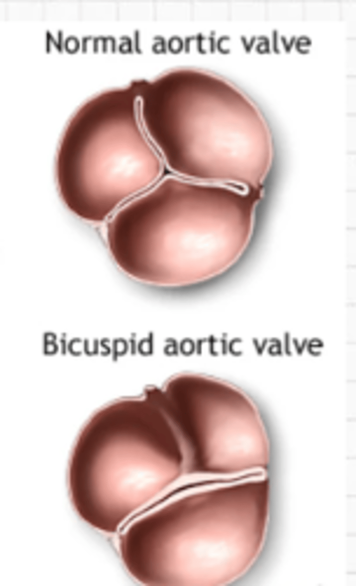 <p>Most common location</p><p>- bicuspid aortic valve instead of tricuspid</p>