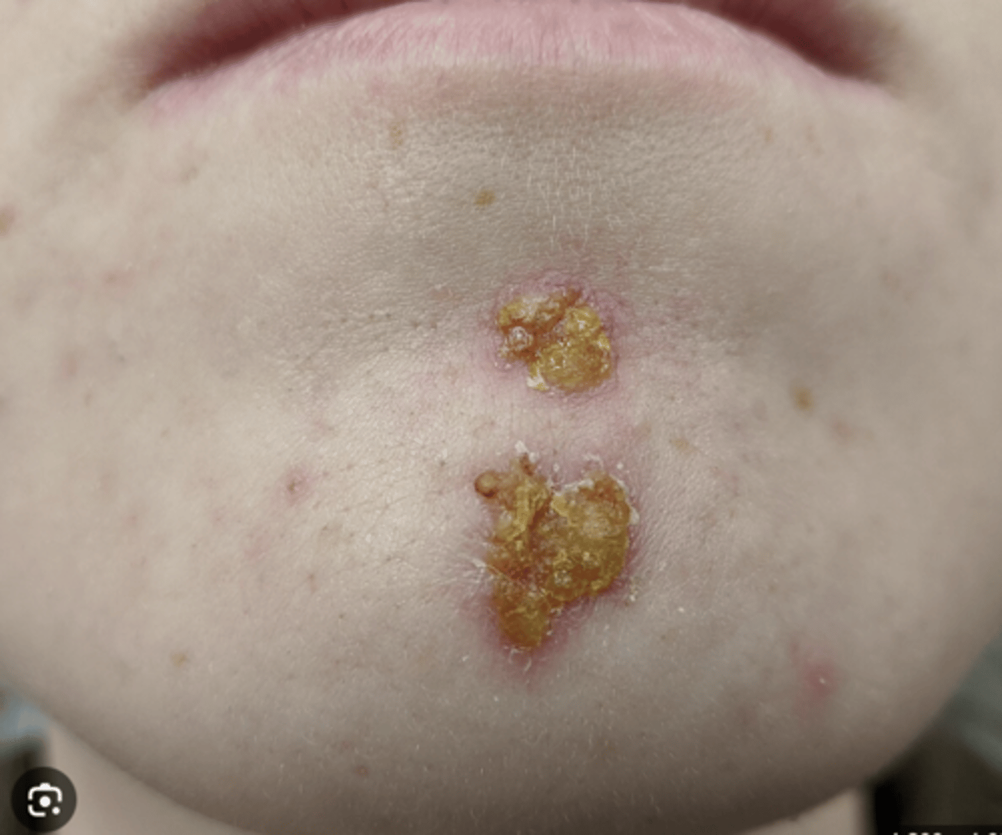 <p>- It typically starts on the face and spreads to other parts of the body.</p><p>- characterised by vesicles that rupture, forming honey-coloured crusts.</p>
