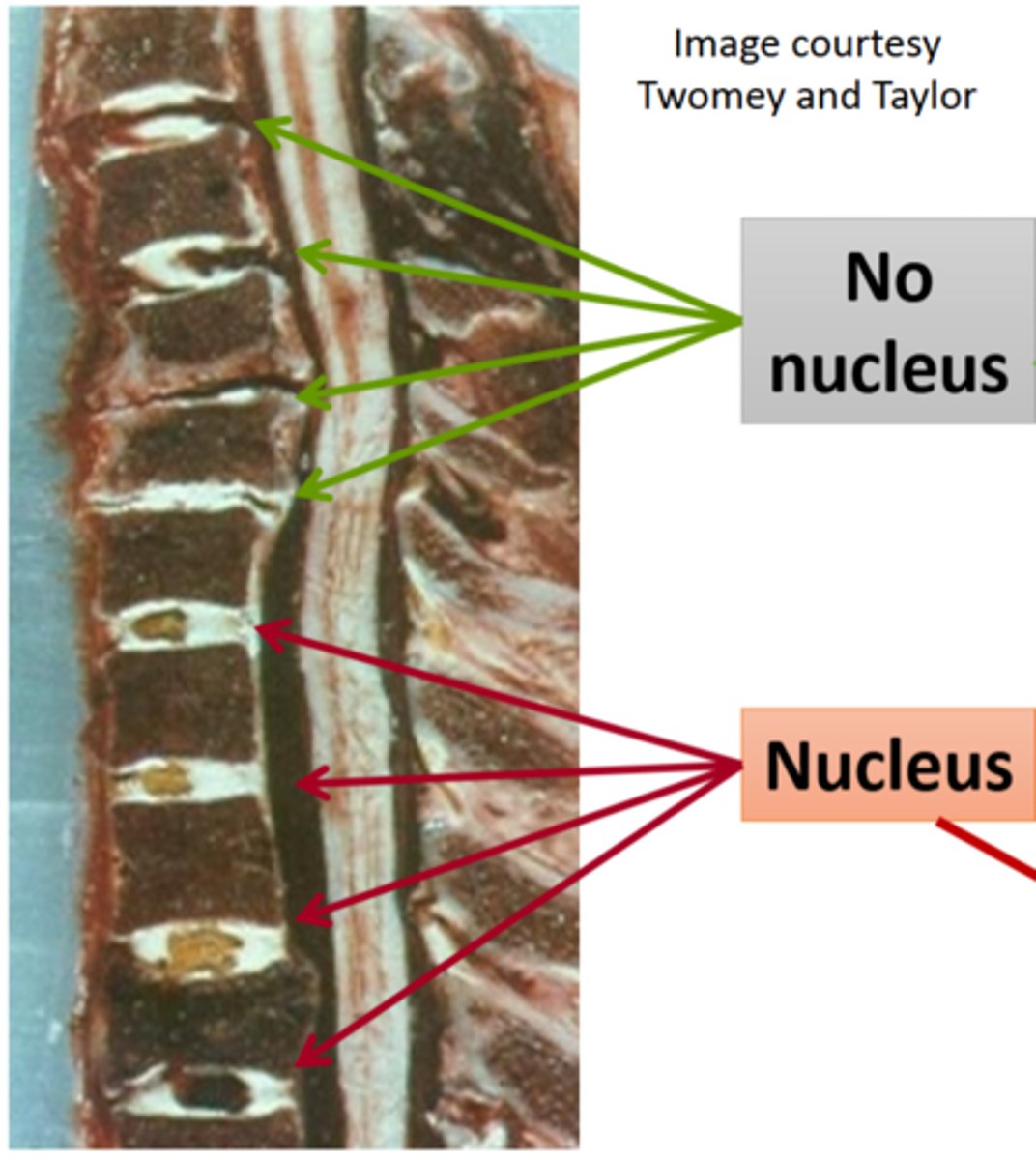 <p>upper (no nucleus) </p><p>- no inflammatory and immune mediated chemicals </p><p>- lower incidence of upper cervical disc injury and radiculopathy </p><p>lower (nucleus) </p><p>- NP contains inflammatory and immune mediated chemicals that irritate nerve roots </p><p>- higher incidence of lower cervical disc injury and radiculopathy </p>