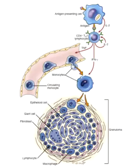 <p><strong>Granuloma Formation</strong> </p><p>Granulomas form when the immune system tries to <strong>wall off substances it cannot eliminate</strong>, such as <strong>persistent microbes</strong>, <strong>foreign material</strong>, or <strong>self-antigens</strong>.</p><p> </p><ol><li><p><strong>Persistent stimulus:</strong><br>A pathogen (like <em>Mycobacterium</em>), foreign body, or resistant antigen remains in tissue and <strong>can’t be cleared</strong> by macrophages.</p></li><li><p><strong>Chronic macrophage activation:</strong><br>Continuous immune signaling (especially <strong>IFN-γ from T helper 1 cells</strong>) activates macrophages, which <strong>enlarge and transform</strong> into <strong>epithelioid cells</strong> (specialized macrophages with secretory function).</p></li><li><p><strong>Cell aggregation:</strong><br>Epithelioid cells <strong>cluster together</strong>, often fusing to form <strong>multinucleated giant cells</strong>.</p></li><li><p><strong>T-cell involvement:</strong><br><strong>Lymphocytes</strong> (mainly CD4⁺ T cells) surround the macrophage core, maintaining activation through cytokine release.</p></li><li><p><strong>Fibrosis (optional):</strong><br>Over time, <strong>fibroblasts</strong> lay down collagen around the lesion, forming a <strong>fibrous capsule</strong> to isolate the persistent irritant.</p></li></ol><p></p>