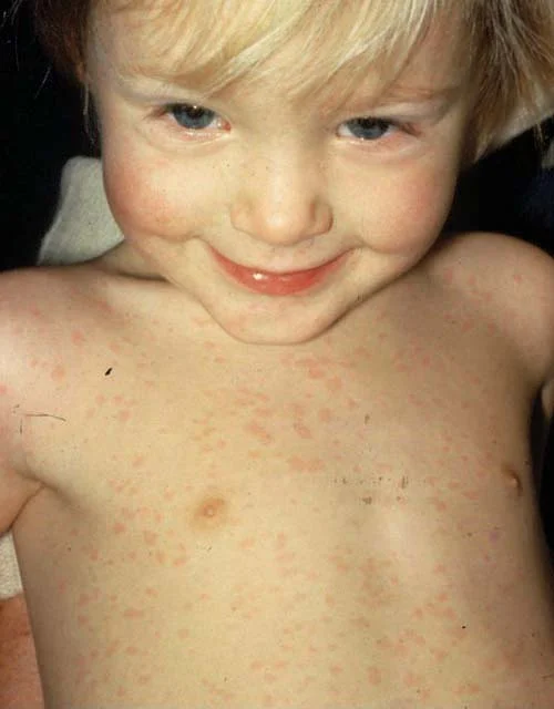 <p>rubeola (virus)</p><p></p><p>pinkish, erythematous macules and papules from face to caudal spread</p><p></p>