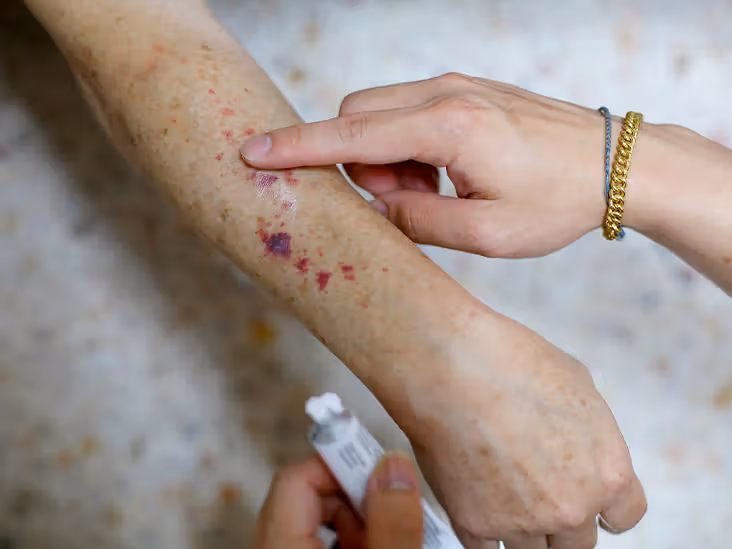 <p>small red or purple spot caused by bleeding into the skin (brighter than bruise)</p>