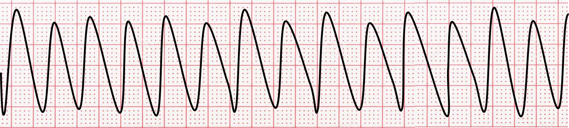 <p>pulseless v tach &amp; torsades. </p>