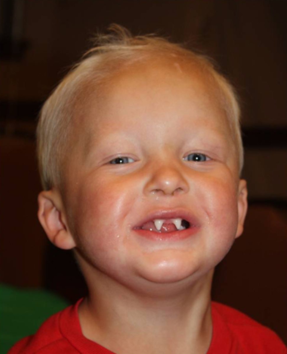 <p>Ectodermal dysplasia</p>