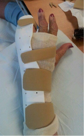 <p>what is the name, type and purpose of this UE orthotic?</p>