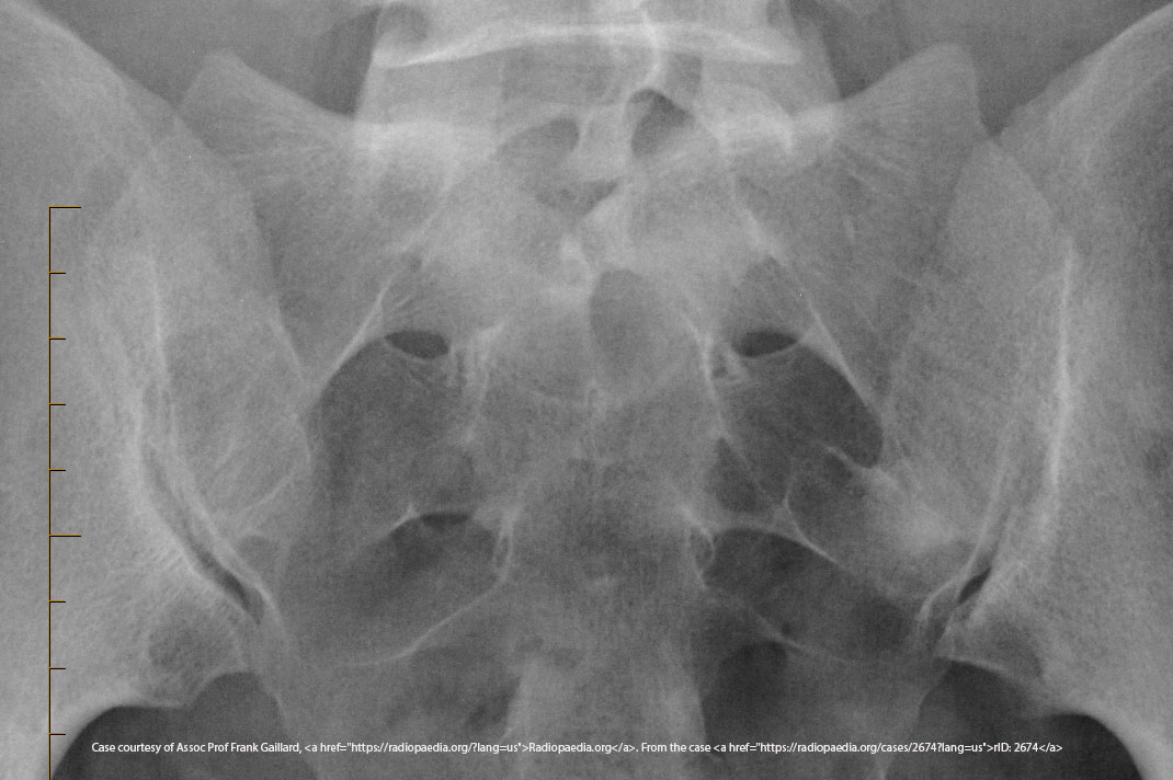 <p>5–6 cm below the ASIS.</p>