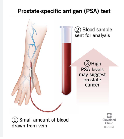 <p>prostate specific antigen</p><p><em>Diagnostic lab test&nbsp;</em></p>