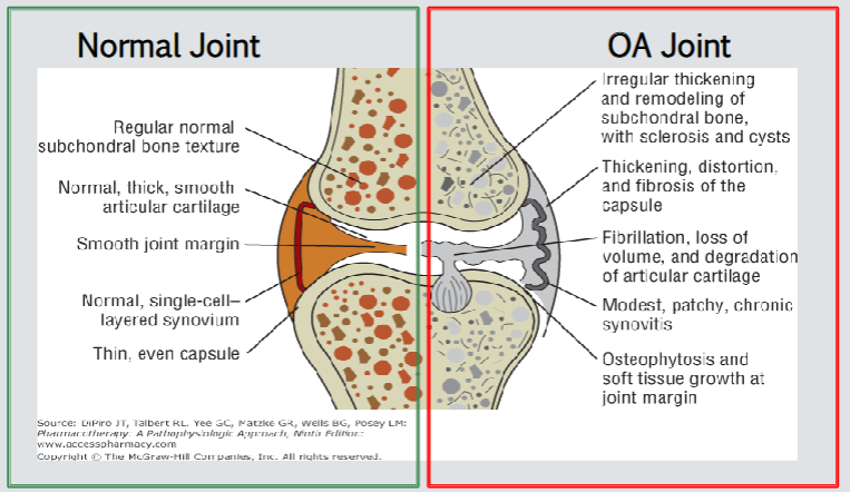<p><strong><u>OSTEOARTHRITIS</u></strong></p><ol><li><p>Diagnosis (3)</p></li><li><p>NO specific ______ for OA</p></li><li><p>Symptoms resolve with …</p></li><li><p>RECURS with …</p></li><li><p>Duration ______</p></li></ol><p></p>