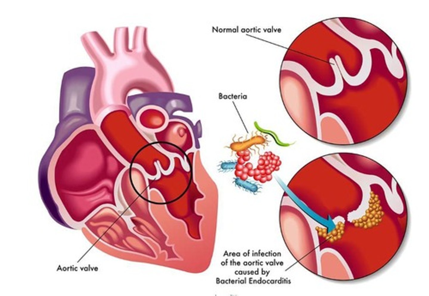 <p>Inflammation of the endocardium—the endothelial membrane that lines the cavities of the heart.</p>