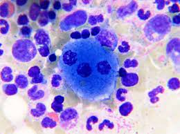 <p>Sea-blue histiocytes</p>