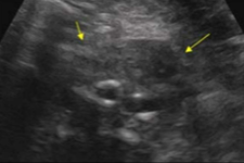 <p>What pathology is seen here in this transverse image of the aorta?</p>
