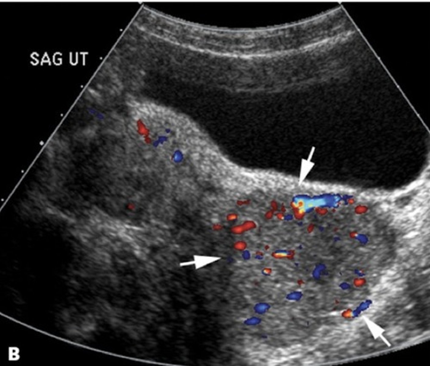 <p>Due to HPV 16 &amp; 18</p><p>Protruding mass from cervix</p>