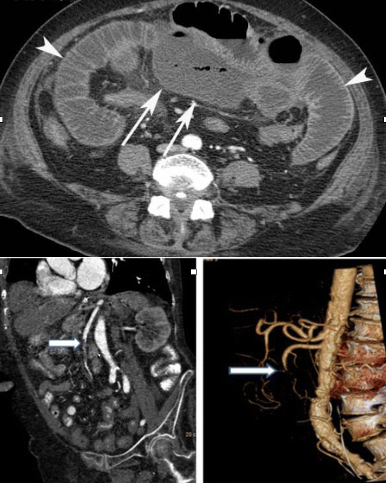 <p><em>CTA Abdomen/Pelvis IV contrast</em></p>