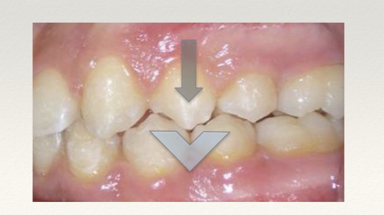 <p><span style="font-size: calc(var(--scale-factor)*22.00px);"><span>❖ </span></span><span style="font-size: calc(var(--scale-factor)*36.00px);"><span>Molar relationship: mesiobuccal cusp of the upper molar, occludes into the mesial groove of the lower molar.</span></span></p><p><span style="font-size: calc(var(--scale-factor)*36.00px);"><span>Distal surface of the distobuccal cusp of the upper first molar occludes on the mesial surface of the mesio- buccal cusp of the lower second molar.</span></span></p><p>Canines and premolars enjoyed a cusp relationship buccally and a cusp-fossa relationship lingually.</p>