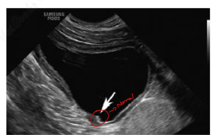 <p>In an ultrasound what is represented focally thickened regions within the urinary bladder wall which slightly protrudes onto the luminal surface of the bladder wall?</p>