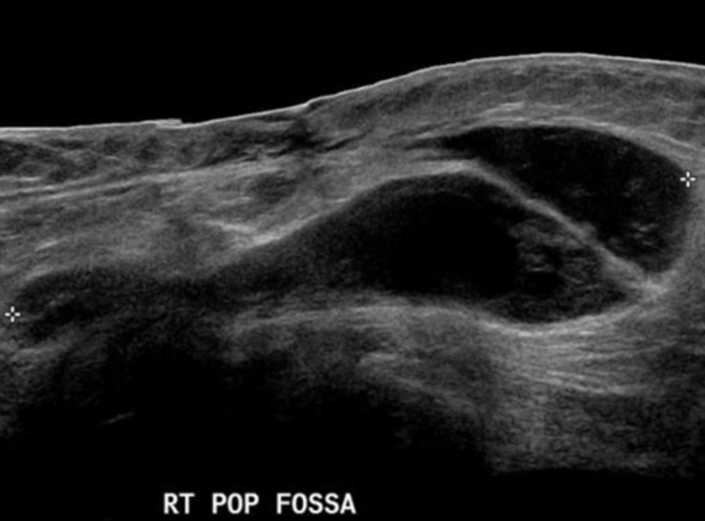 <p>Leaking synovial fluid into joint space</p><p>Connect to knee joint in medial popliteal fossa</p><p>Rupture looks like rat tail</p>