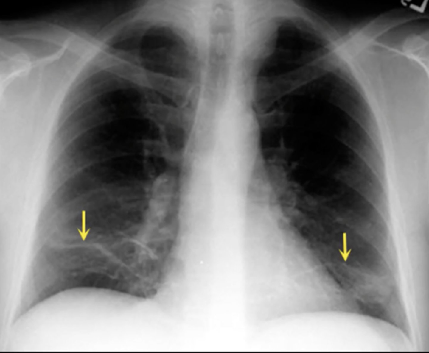 <p>(CXR examples) lung collapses on itself; forms a plate like line</p>