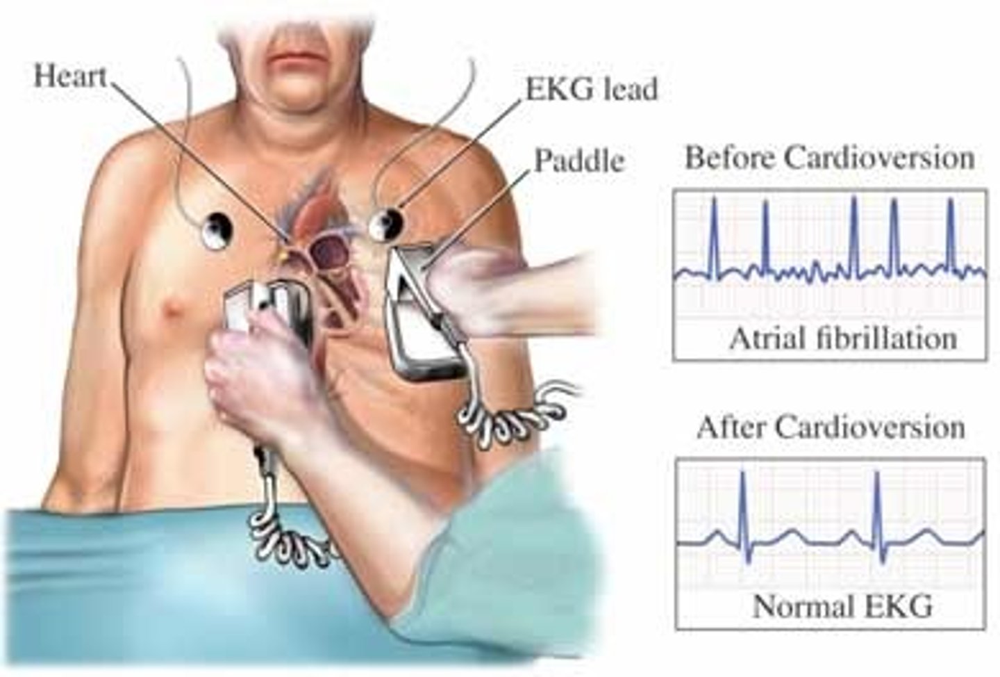 <p>If hemodynamically unstable</p><p>- Cardioversion</p>