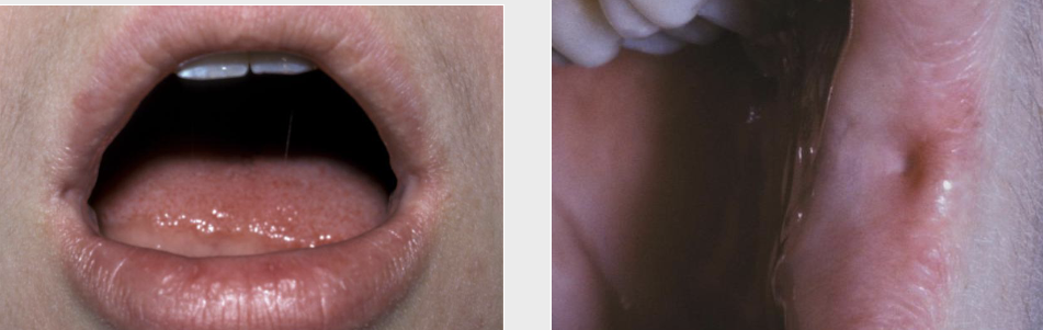 <ul><li><p><span style="color: #000000">Mucosal invaginations that occur at the corners of the mouth on the vermilion border</span></p></li><li><p><span style="color: #000000">NOT associated with facial or palatal clefts</span></p></li><li><p><span style="color: #000000">No treatment required</span></p></li></ul><p></p>