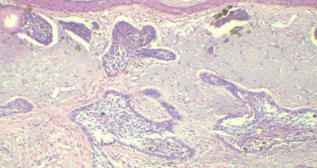 <p>Which one: <strong>Basal Cell Carcinoma</strong> OR <strong>Normal Epithelium</strong></p>