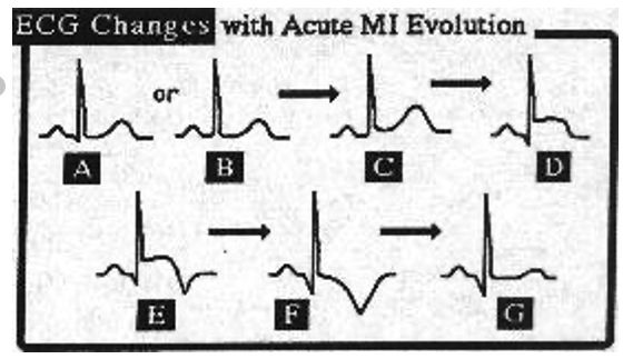 <p>How do ECG readings change with acute MI evolution? </p>