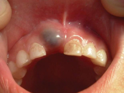 <p><strong>Children</strong>, overlying the crown of erupting deciduous or permanent tooth, subsides whentooth erupts</p>