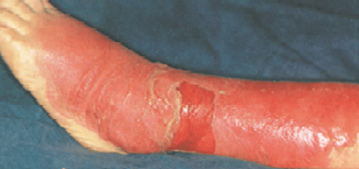 <p>Erysipelas (red skin); painful cellulitis involving blockage ofdermal lymphatics, therefore, lesions have sharp raised border</p>
