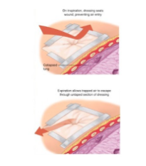 <ul><li><p>High flow O2</p></li><li><p>Place a 3 sided dressing over the wound to create a makeshift external one-way valve.</p></li><li><p>Chest drain insertion.</p></li></ul>