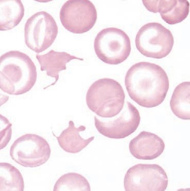<p><span style="font-family: "Times New Roman", serif">RBC with irregular, spiky projections; seen in liver disease, abetalipoproteinemia.</span></p>