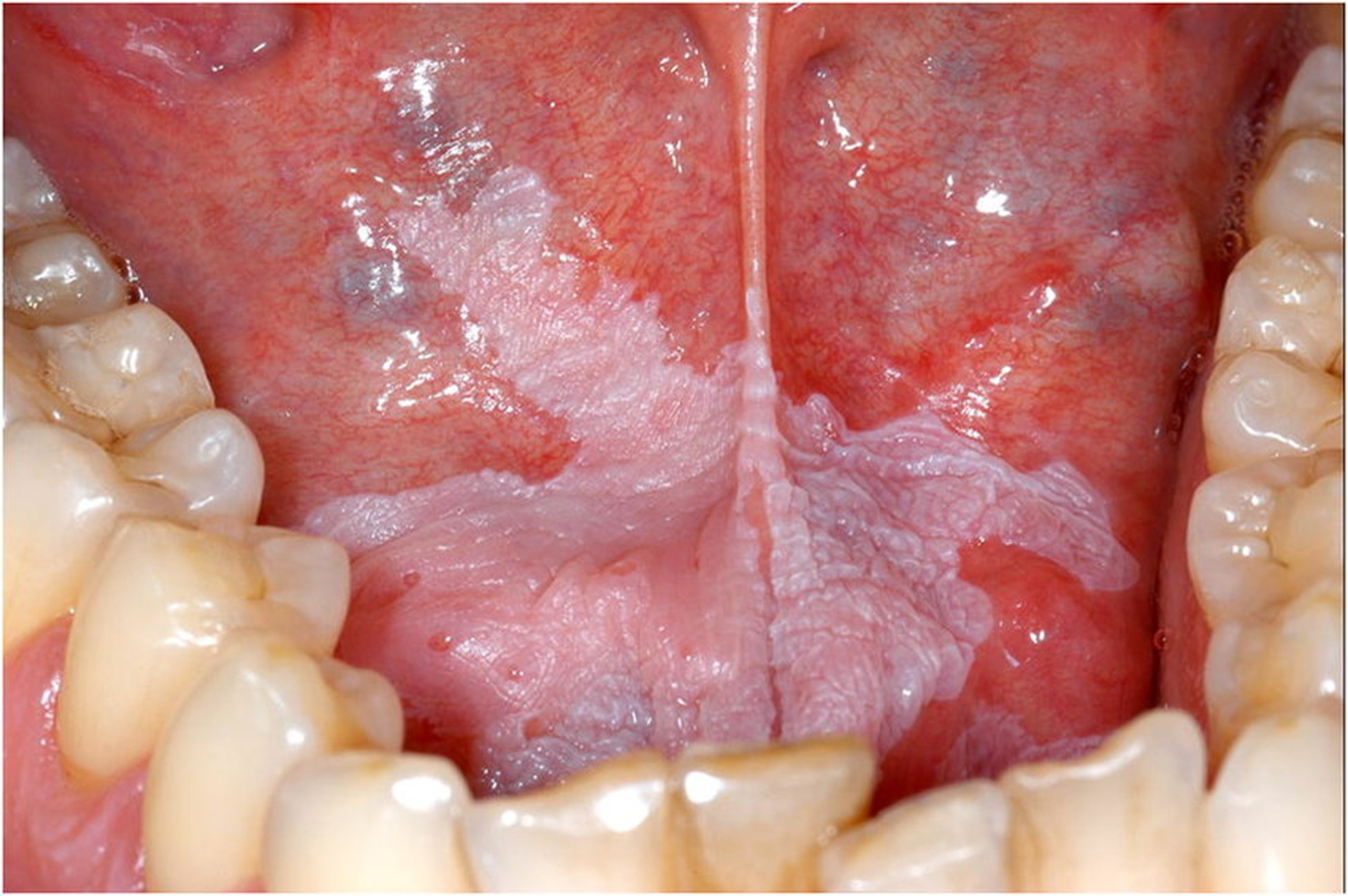 <p>Chemopreventive agent used for <strong>Oral Leukoplakia?</strong></p>