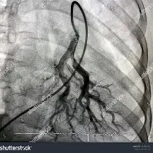 <p><span style="color: rgb(181, 137, 22);">CT <strong>Pulmonary Angiography</strong></span></p><ul><li><p>uses contrast so note allergies!!</p></li></ul><p></p><p>Use <span style="color: rgb(148, 102, 28);"><strong>VQ scan</strong></span> (Ventilation/Perfusion scan) if contrast contraindicated</p>