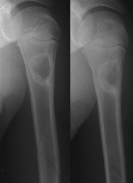 <p>Bone Cyst</p>