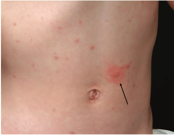 <p>scrape skin → red, swollen and possible wheal → urticaria pigmentosa</p>