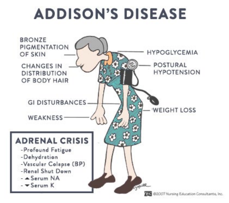 <p>● The unique manifestation of Addison’s Disease is the skin discoloration. There is bronze pigmentation of the skin</p><p>● Hypoglycemia and Low Blood Pressure</p><p>● Profound/Chronic Fatigue</p><p>● Weight Loss</p><p>● Dehydration</p><p>● Craving for Salty Food</p>
