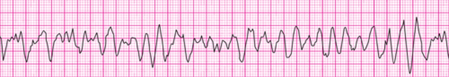 <p>Ventricular fibrillation</p>