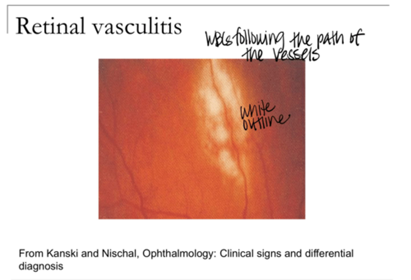 <p>Retinal Vasculitis -- WBCs following the path of the BVs (Pic)</p>