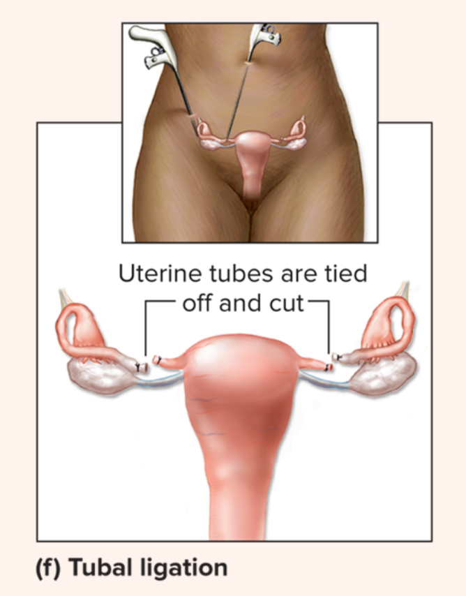 <p>Tubal ligation</p>