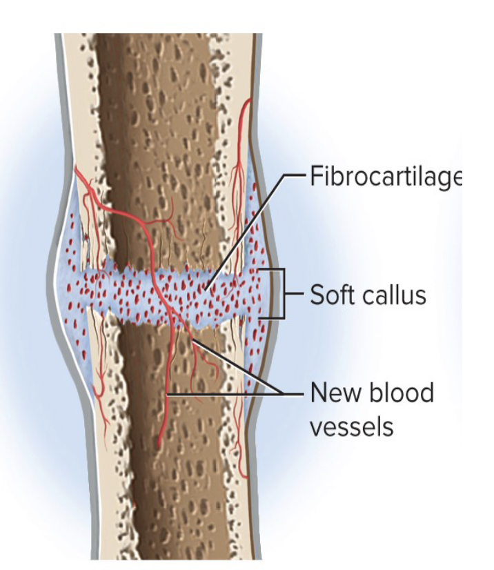 <ul><li><p>Fibroblasts deposit <strong>collagen</strong></p></li><li><p>Osteogenic cells turn into <strong>chondroblasts, </strong>which make <strong>fibrocartilage</strong></p></li><li><p>Collagen + fibrocartilage = <strong>soft callus</strong></p></li></ul><p></p>