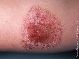 <p><span>A scab, caused by the leaking of blood or plasma through a lesion.</span></p>