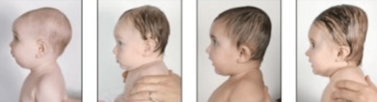 <p>premature fusion of the coronal sutures resulting in the shortening of the skull in the anterior-posterior direction.</p>