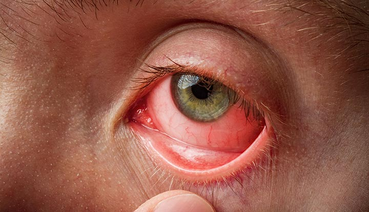 <p>PP: diffuse dilation of conjunctival vessels+redness<br>maximal peripherally</p><p>E: bacterial<br>viral<br>infections<br>contagion<br>allergy<br>irritation</p><p>CM: no pain→mild discomfort<br>no vision affected (discharge→temporary mild blurring)<br>watery/mucoid/mucopurulent discharge<br>pupil not affected<br>clear cornea</p>