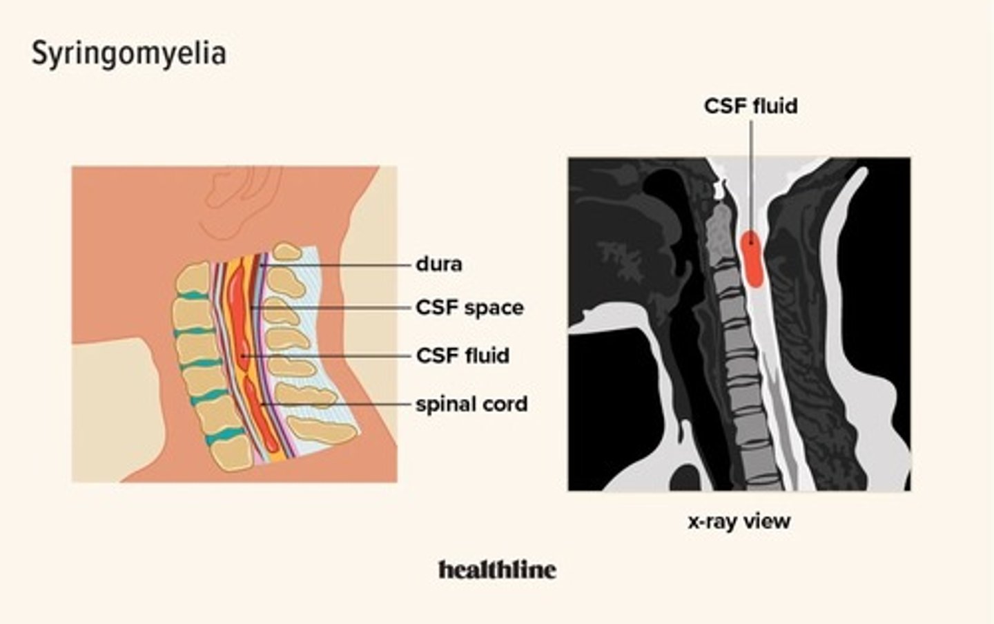 <p>- bij obstructie hartcyclus gebonden liquorcirculatie over craniocervicaal</p><p>- spinale liquor -> cervicothoracaal ruggenmerg</p><p>- cystische liquorcollectie</p><p>- oz -> Chiari malformatie (soms posttraumatische arach adhesie)</p>