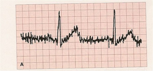 <ul><li><p>caused by irregular muscle movement (Parkinson’s, shivering from cold, etc)</p></li></ul><p></p>