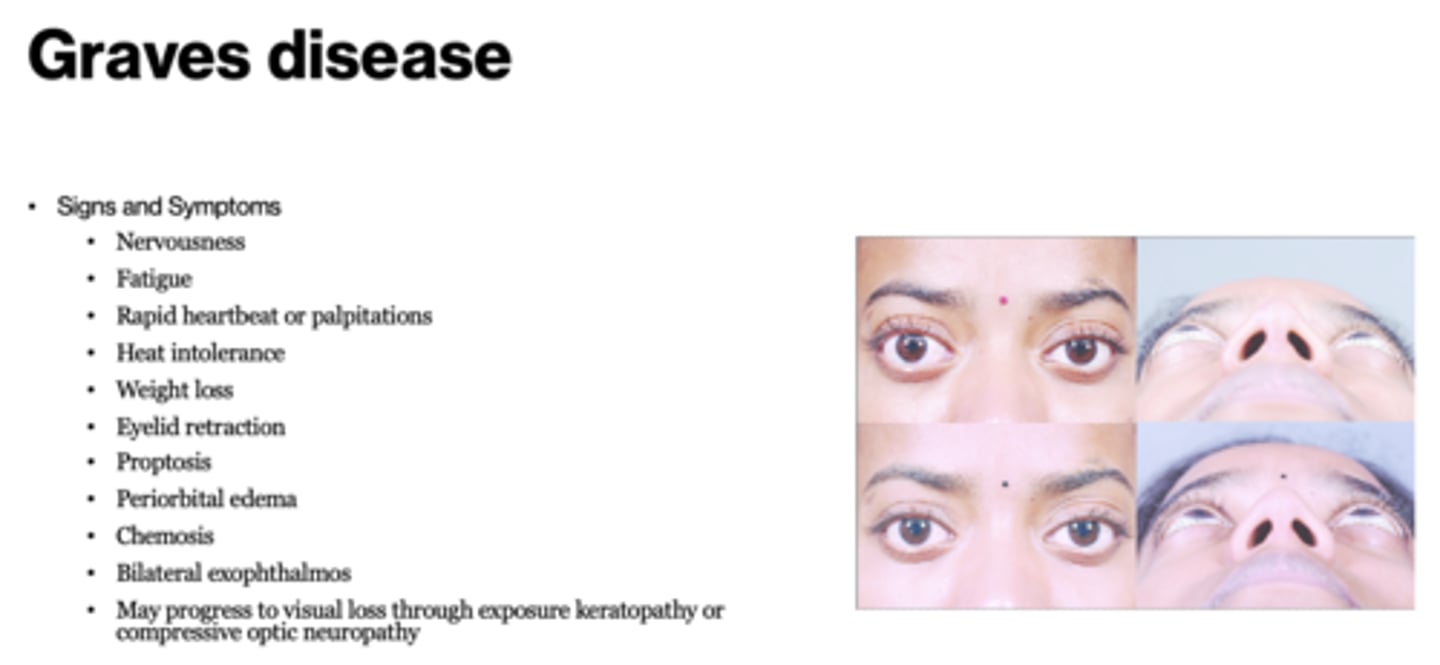 <p>Graves disease (hyperthyroidism)</p>