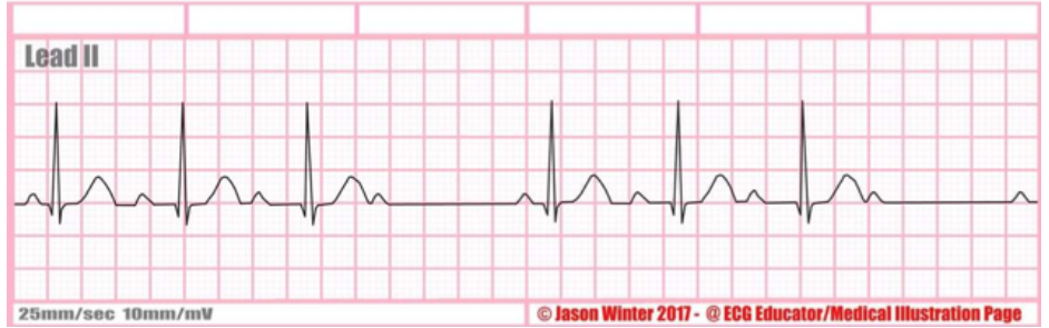<p>type of abnormality + characteristics?</p>