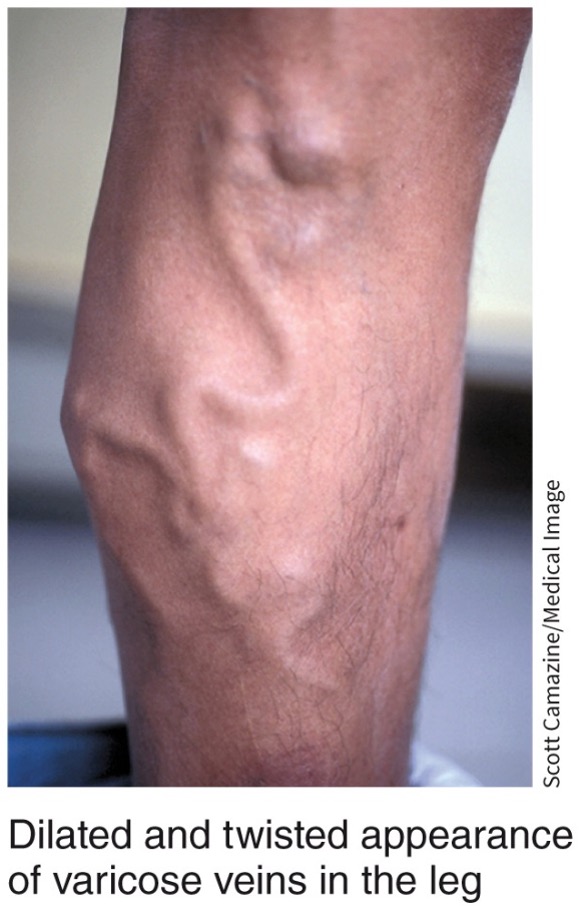 * formed when venous valves become weak or damaged
* veins are dilated and twisted in appearance
* dark blue or purple color
* veins protrude above the surface of the skin and can lead to pain, burning and spasms
