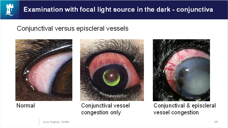 <p>Pain, vision loss, corneal oedema, episcleral vessel congestion, fixed dilated pupil.</p><p></p><p></p><p>Episcleral vs conjunctiva:</p><p></p>