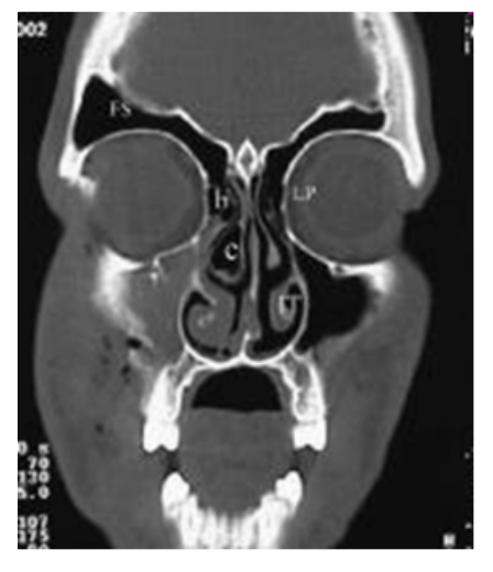 <p>A patient with foul rhinorrhea, maxillary pain on the right with fever consults you. He was seen by another MD and CT scan was done. What sinus abnormality is clearly demonstrated in this CT scan of the PNS?</p><p>A. Concha bullosa</p><p>B. Maxillary sinusitis</p><p>C. normal PNS CT scan</p><p>D. none of the above</p>