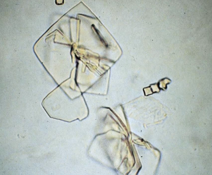 <p>What is the name of this crystal? </p><p>What does it do to the body?</p><p>Is this crystal present in alkaline or acidic urine?</p>